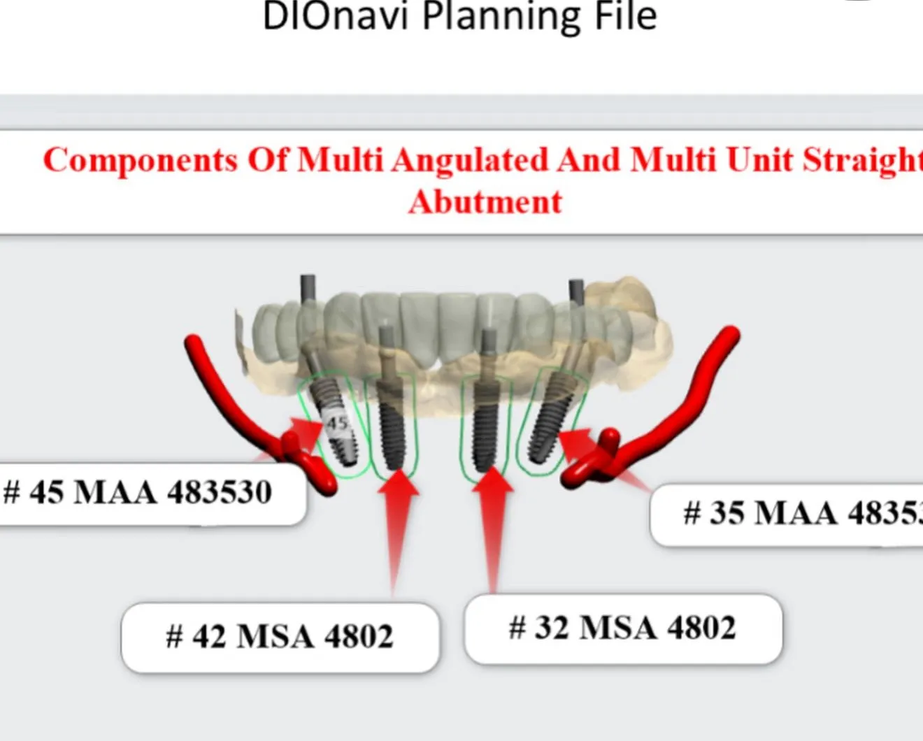 Dio Navi Guide’lı Cerrahi Aşamaları